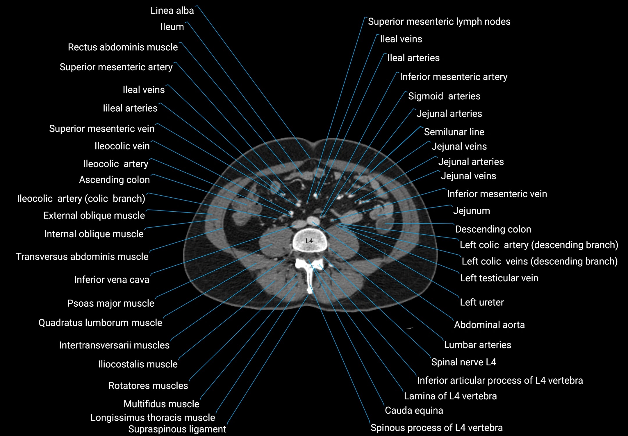CT male pelvis axial cross sectional anatomy labelled radiology image -00111.webp